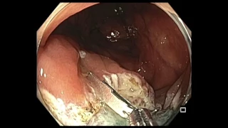 Colonoscopy: IC valve SSA - EMR - Central clip closure followed by periphery closure