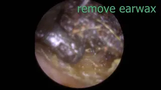 【ASMR】Experience the most professional visual earwax cleaning and relaxing ear massage！Part 37