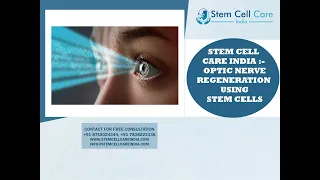 Optic nerve regeneration using stem cells | Best Treatment For Optic Nerve | Stem Cell Therapy |