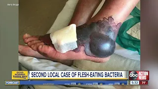 Ohio man contracts flesh-eating bacteria in Tampa Bay