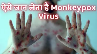 How Monkeypox virus KILLS? (3D Animation) #shorts