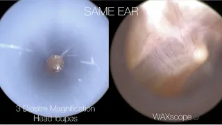 153 - Ear Wax Removal with View A or B?? You Decide!