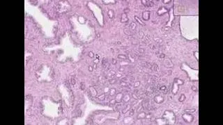 Histopathology Prostate --Adenocarcinoma (Gleason grade 2)