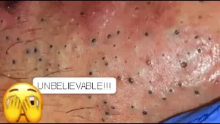 UNBELIEVABLE !!! A FACE FULL OF BLACKHEADS 😨 YOU HAVE NEVER SEEN THIS BEFORE PART 2 #relaxing