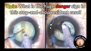 Huge danger sign seen during resident cataract surgery!