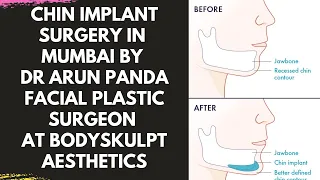 Chin Implant Surgery in Mumbai by Dr Arun Panda Facial Plastic Surgeon at Bodyskulpt Aesthetics