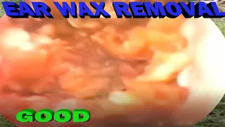 Most Irritating Ear Wax  Deep Impacted Hard Stuck Ear Wax Removal.(Keep Healthy ear wax) Spa EP178