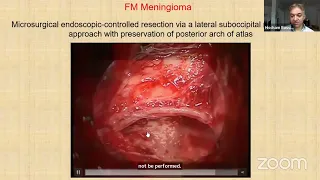Treatment of foramen magnum meningiomas/PD Dr. Med. Hischan Bassiouni