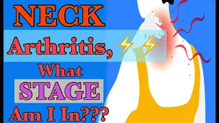 Neck Arthritis (2024) | Stages of Degeneration | Dr. Frank Altenrath Chiropractor in Cresskill, N.J.