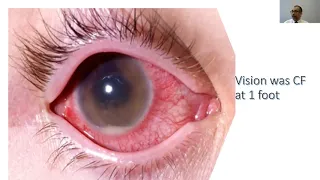 Endophthalmitis Retained Lens Fragment Diabetic Mac Edema Uveitis Webinar 5.6.2020 Dr Hasan Bahrani