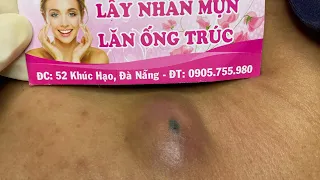 OMG Make your Acne treatment Thu Đà Nẵng |07| Acne 2022