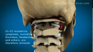 C1 and C2 Atlantoaxial Instability: Upper Cervical Instability and Prolotherapy animation