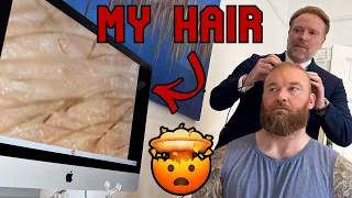 I GOT A NEW HAIR TRANSPLANT! - Hafþór Björnsson
