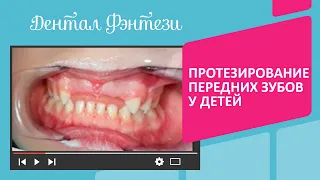 🦷 Протезирование передних зубов у детей