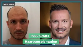 Haartransplantation Türkei ✅ Vorher - Nachher mit 6900 Grafts [Dr. Erkan Demirsoy]