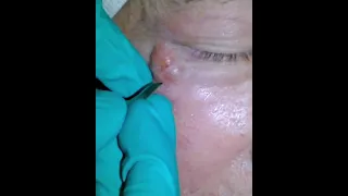 Superficial abscess after deep space infection was treated