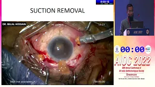 AIOC2022 GP196  topic Dr Billal Hossain How to Handle Nucleus Drop