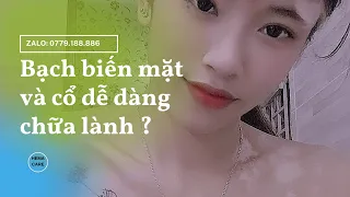 ‼️ BẠCH BIẾN VÙNG MẶT VÀ CỔ CHỮA DỄ DÀNG HIỆU QUẢ | Điều trị bạch biến cùng HemaCare