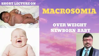 WHAT IS MACROSOMIA-  CAUSES OF OVER WEIGHT NEWBORN BABY- FETAL MACROSOMIA