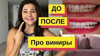 Что такое виниры для зубов? Мой опыт 😃 Сколько стоит установить виниры отзывы