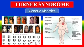 TURNER SYNDROME - Definition , types , cusses , Pathophysiology , signs , diagnoses,  treatment ,