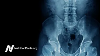 Do Vegans Have Lower Bone Mineral Density and Higher Risk of Osteoporosis?