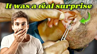 It was a Real Surprise! #earwax #earwaxremoval