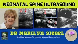DR MARILYN SIEGEL | NEONATAL SPINE ULTRASOUND | Normal Anatomy | Tethered Cord |  Myelomeningocele
