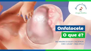 Cirurgia Infantil Channel | Onfalocele, o que é?