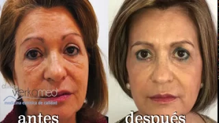 Blefaroplastia sin cirugía en Clínica Verkomed Sevilla! Nuestra paciente Pepi y su gran cambio!