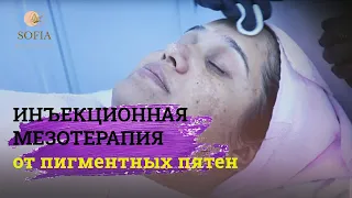 Процедура мезотерапии от пигментных пятен