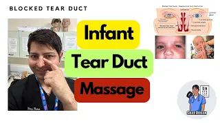 Tear Duct Massage (Crigler) For Infants for Blocked Tear Duct #Crigler #tearductobstruction