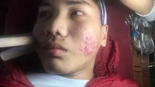 Acne red, poisonous blood suck with bamboo tubes in Hội An part 1 ( 23/11/2019)