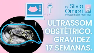 ULTRASSOM OBSTÉTRICO - GRAVIDEZ 17 SEMANAS - ULTRASSONOGRAFIA EXPLICADA - DESENHO - CONTORNO DO BEBÊ