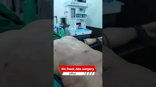 Six Packs Abs Surgery Cost in Delhi, India #shorts