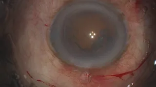 Peripheral corneal degeneration and arcus cataract surgery