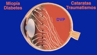 Desprendimiento de Vítreo: Cuerpos flotantes, moscas y luces - Centro de Oftalmología Bonafonte
