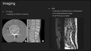 Thoracolumbar Burst Fractures