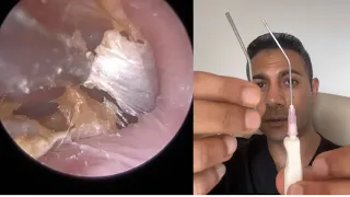 1,510 - Extremely Itchy Dead Skin Accumulation Removed from Ear | Learn About Zoellner Suction Probe