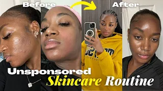 MY *Unsponsored* 6-STEP SKINCARE ROUTINE FOR ACNE PRONE, SENSITIVE, DRY SKIN | FADE SCARS & TEXTURE