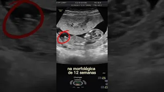 Nem deu tempo do médico falar… #sexodobebe #shorts #gravidez #gestante #charevelacao #bebe #gravida