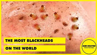 Suri Job 40: THE MOST BLACKHEADS ON THE WORLD