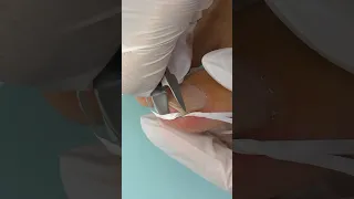 INGROWN TOENAIL 🦶 hack DIY - Worked for Me !