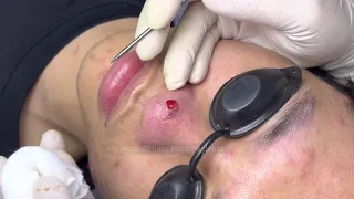 Best blackhead extraction on the face // Loan Nguyen // December #06