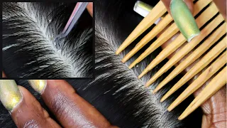 ASMR | Allzoomed Nitpicking & Scratching Scalp Whiteheads With Tweezers