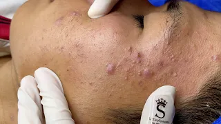 Acne And Pimples | Mụn Ẩn, Mụn Viêm - SacDepSpa#337