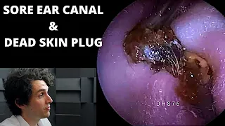 Sore Ear Canal After Hard Dead Skin Plug Extracted