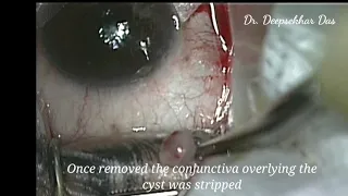 Conjunctival cyst excision with Conjunctival autograft