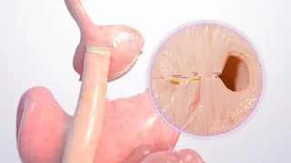 TORe (Transoral outlet reduction) Animation