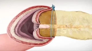 Laparoscopic Blumgart-style Pancreaticojejunostomy